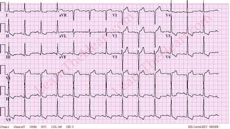 left ventricular hypertrophy with repolarization abnormality.